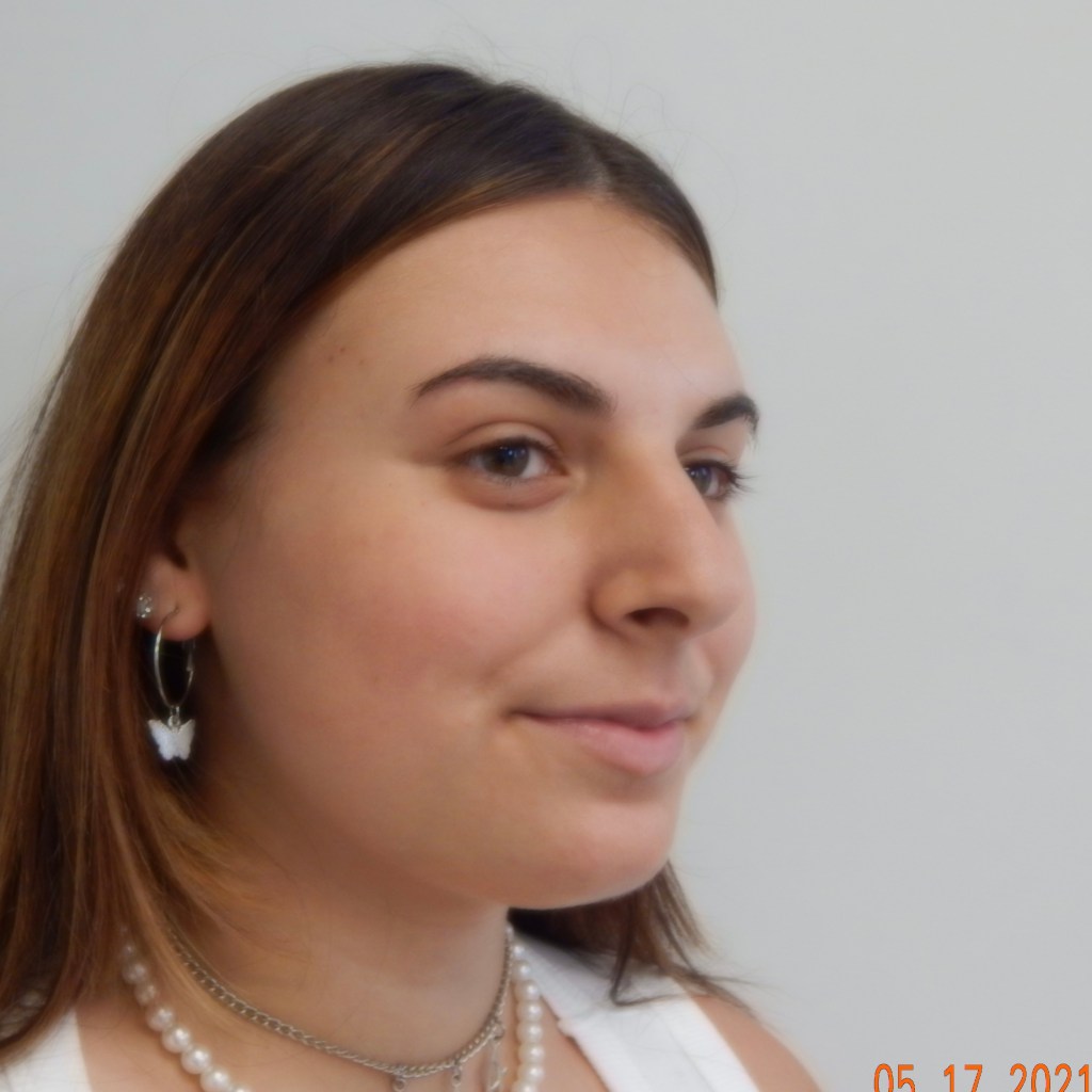 Customized rhinoplasty results showing nasal dorsum bump removal and refined nasal tip — natural nose job by Dr. Elkowitz, New York