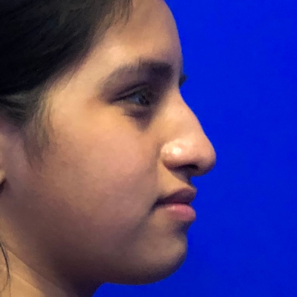 Pre-operative before photo of rhinoplasty patient showing nasal dorsum bump prior to nose job surgery by Dr. Elkowitz, Plastic Surgery of New York