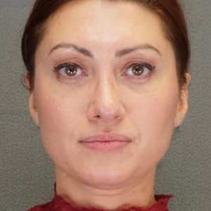 Woman eyebrow lift rhinoplasty and eyelid surgery natural results – Plastic Surgery of New York – front view pre op zoomed in