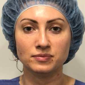 Woman eyebrow lift rhinoplasty and eyelid surgery natural results – Plastic Surgery of New York – front view preop