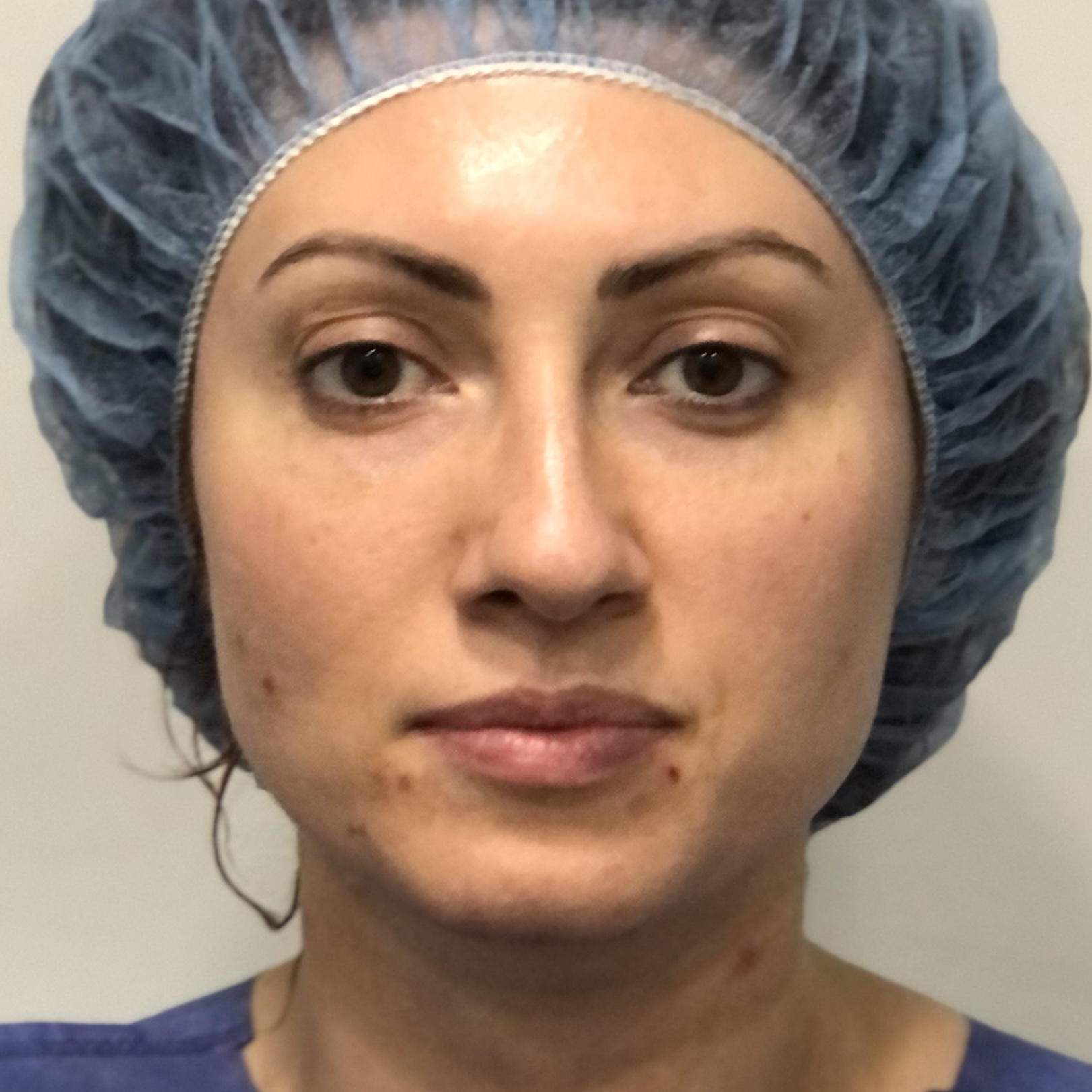 Woman eyebrow lift rhinoplasty eyelid surgery before natural results front view - Dr. Elkowitz Great Neck NY