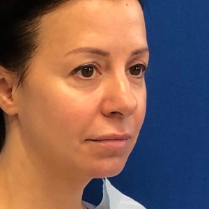 Подтяжка бровей у молодой женщины: невероятное преображение, скрытый рубчик, естественный результат — пластическая хирургия Нью-Йорка — вид в косой проекции до операции