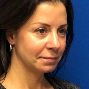 Подтяжка бровей у молодой женщины: невероятное преображение, скрытый рубец, естественные результаты — Пластическая хирургия Нью-Йорка — вид в три четверти после операции