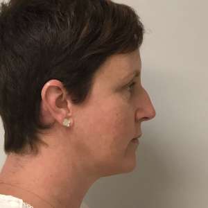 Young woman jowling facelift neck lift blepharoplasty after results - jawline restoration natural results Long Island NY – lateral post op zoom in