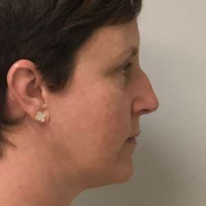 Young woman jowling facelift neck lift blepharoplasty after results - jawline restoration natural results Long Island NY – side post op zoom in
