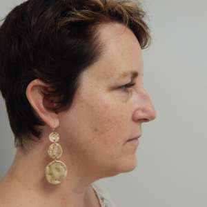 Young woman jowling facelift neck lift blepharoplasty before photo - early facial aging Dr. Elkowitz Great Neck NY – lateral pre op zoom out