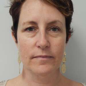Young woman jowling facelift neck lift blepharoplasty before photo - early facial aging Dr. Elkowitz Great Neck NY – front pre op zoom in