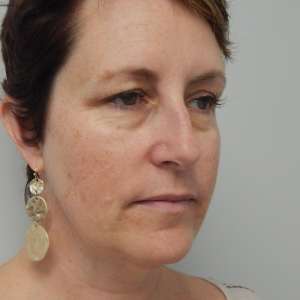 Young woman face neck lift and eyelid surgery natural beautiful rejuvenation results – Plastic Surgery of New York