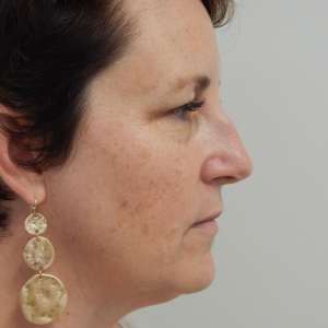 Young woman jowling facelift neck lift blepharoplasty before photo - early facial aging Dr. Elkowitz Great Neck NY – Side pre op zoom in