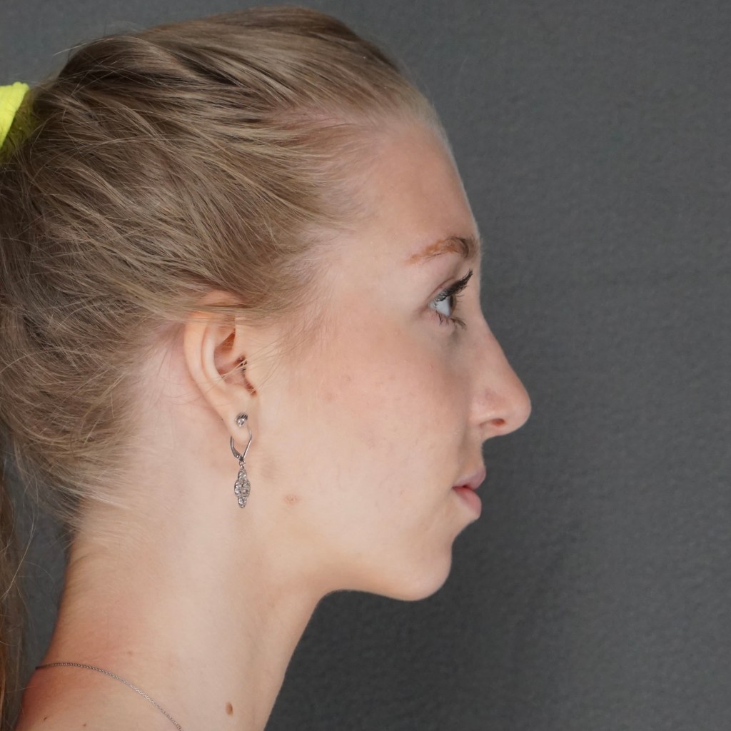 nose job, rhinoplasty, nasal dorsum, bump, nasal tip Customized Natural Beautiful Rhinoplasty – post op side