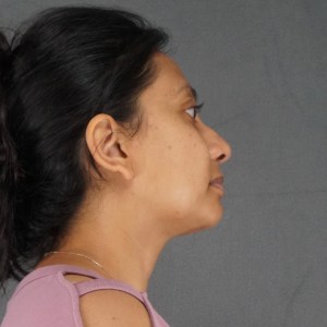 Young woman scarless liposuction neck sculpting and lower eyelid surgery – natural beautiful results – Plastic Surgery of New York post op – post op side
