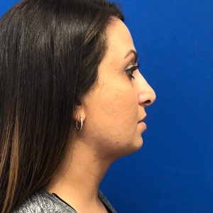Young woman scarless neck sculpting with liposuction – natural beautiful results – Plastic Surgery of New York after – side