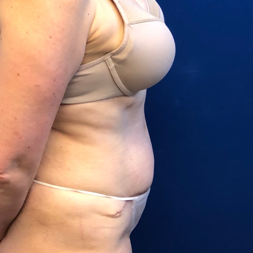 tummy tuck abdominoplasty before and after