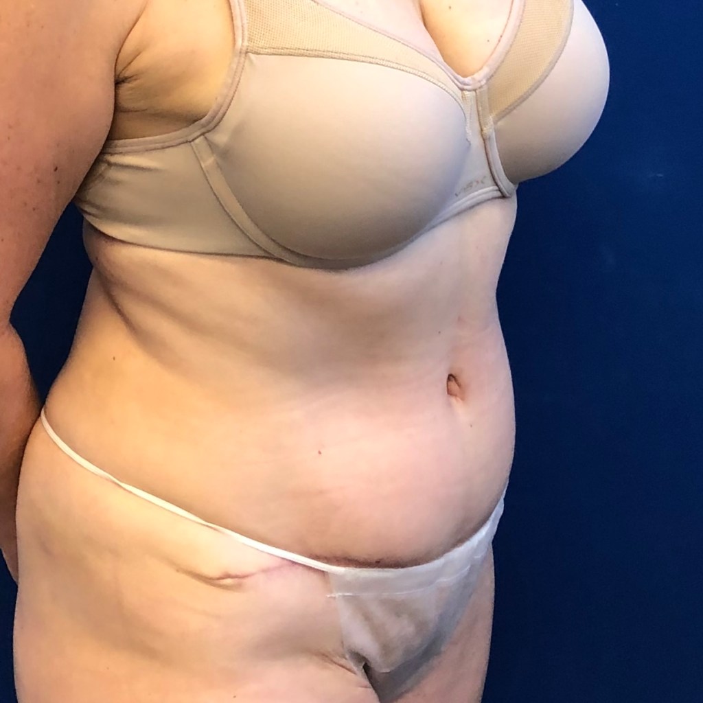 tummy tuck abdominoplasty before and after