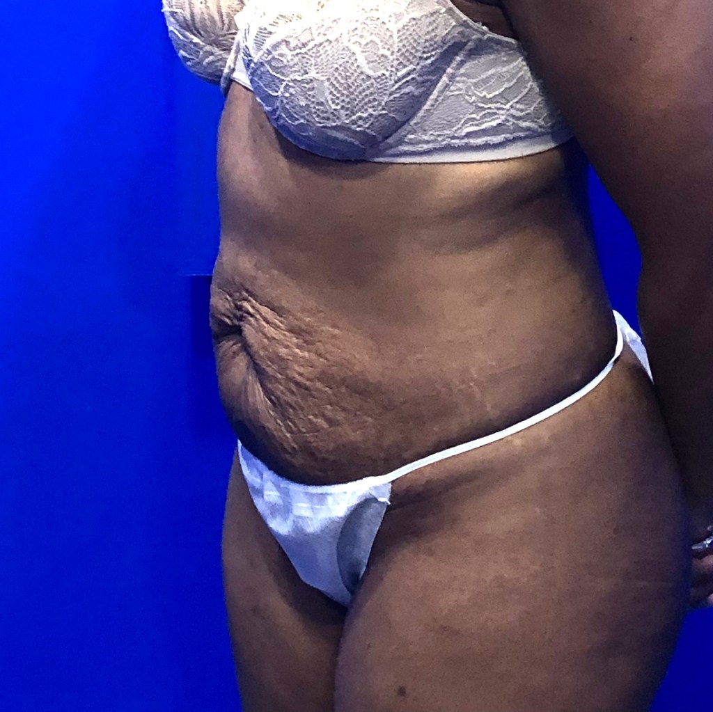 tummy tuck abdominoplasty before and after