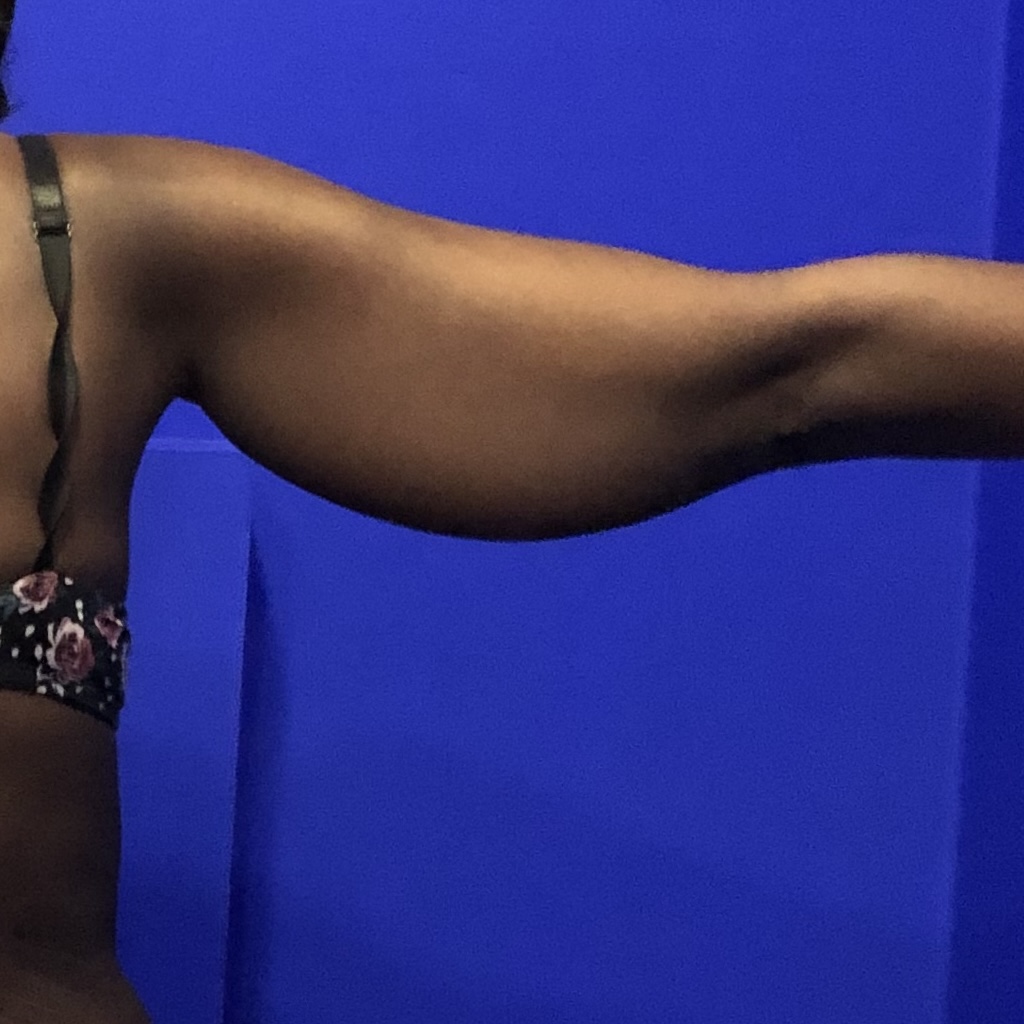 arms, brachioplasty, upper arms, fat arms, arm contouring, arm liposuction