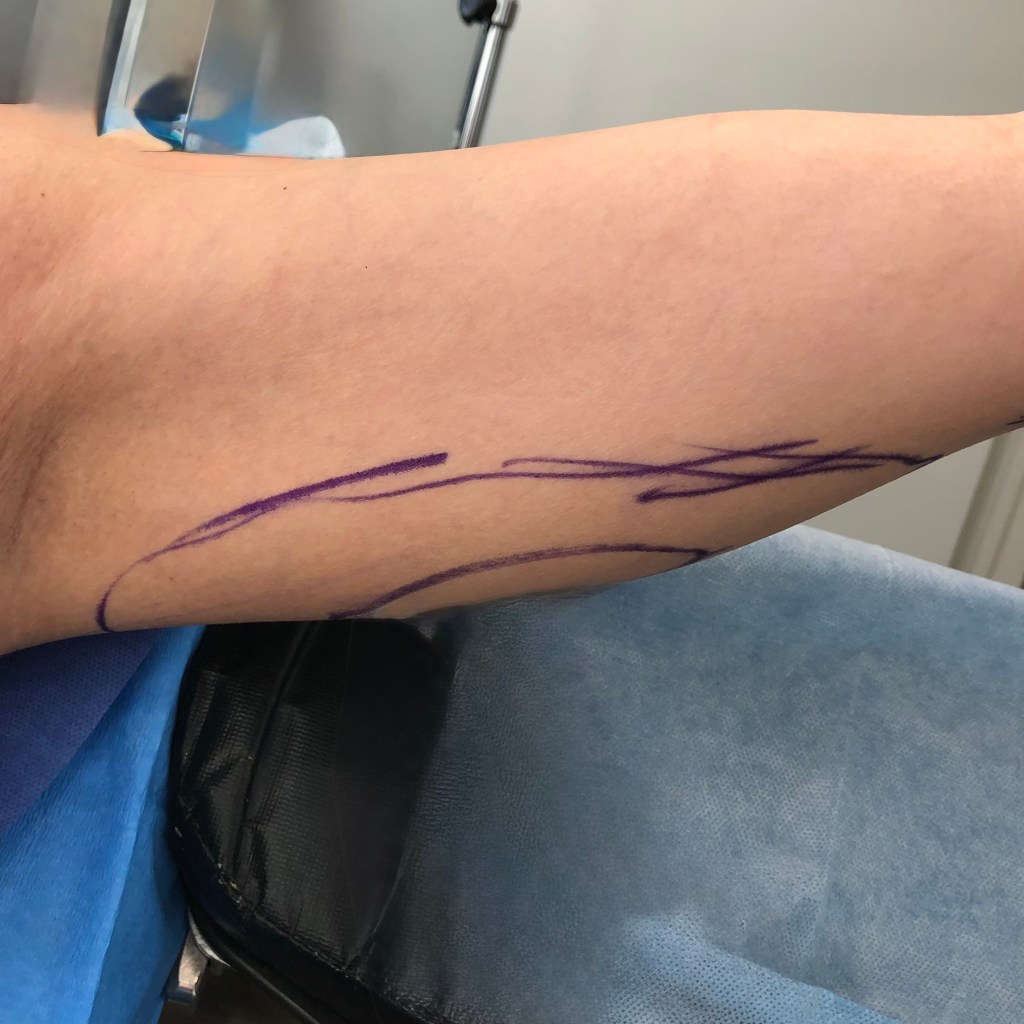 arms, brachioplasty, upper arms, fat arms, arm contouring, arm liposuction