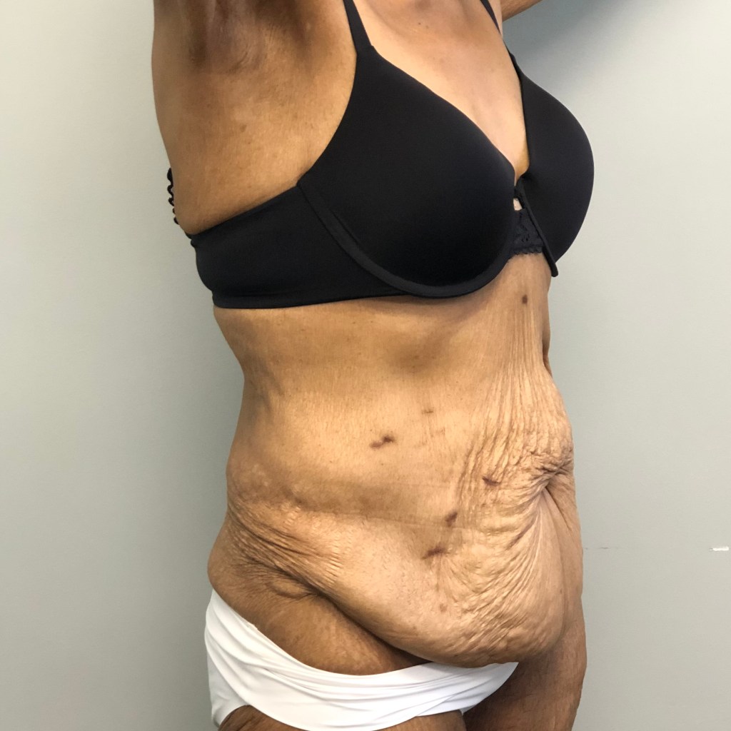 tummy tuck abdominoplasty medial thigh lift lateral thigh lift before and after