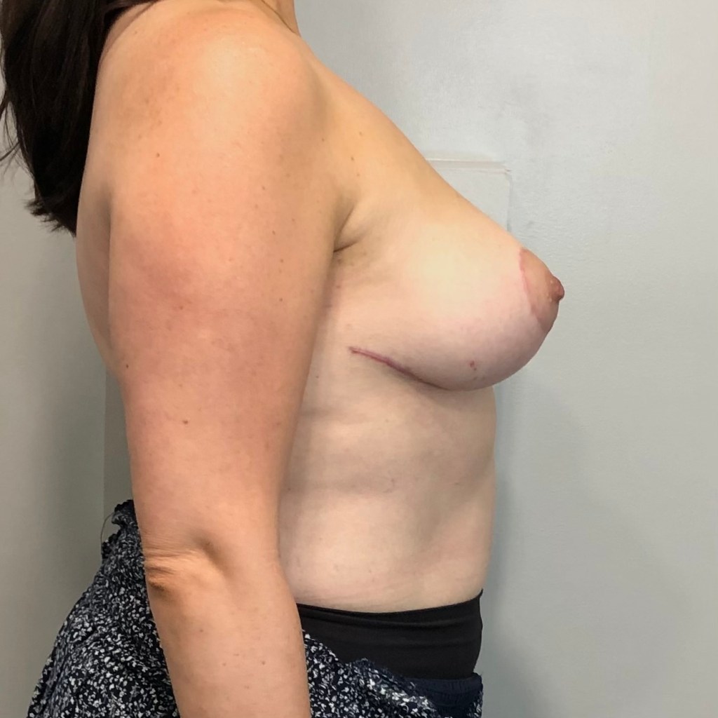 breast lift, mastopexy before and after