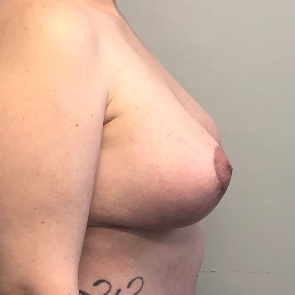 breast augmentation, breast implants, breast lift, mastopexy, breast sagging