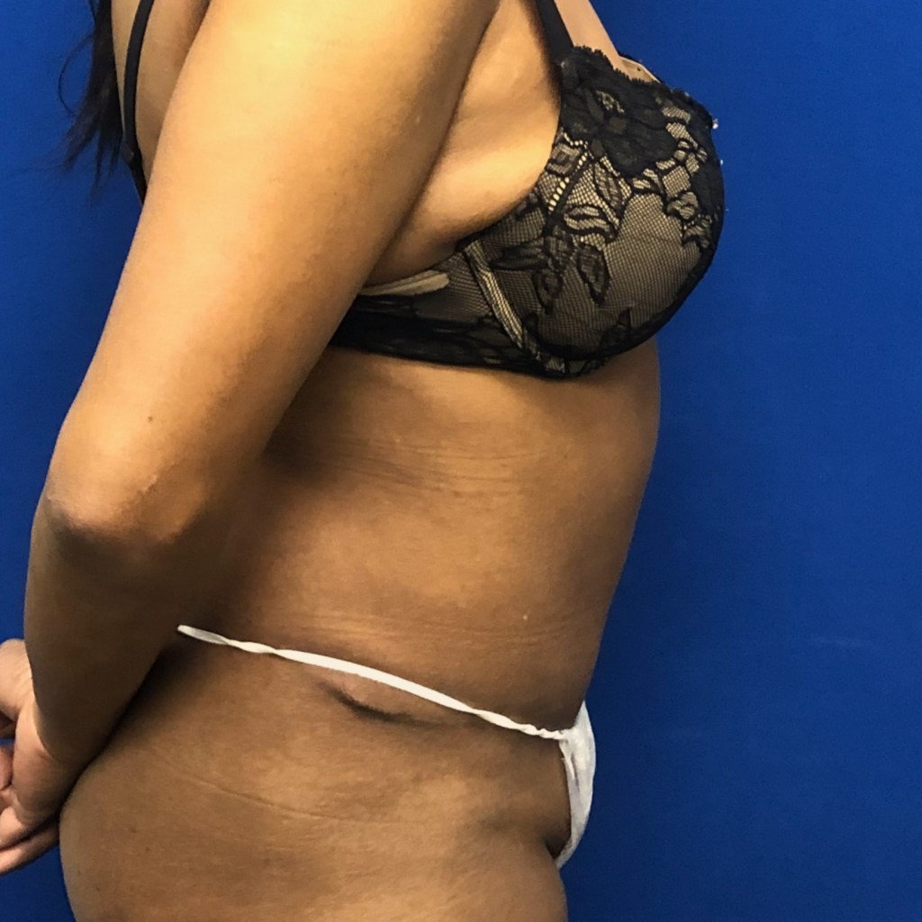 tummy tuck abdominoplasty before and after