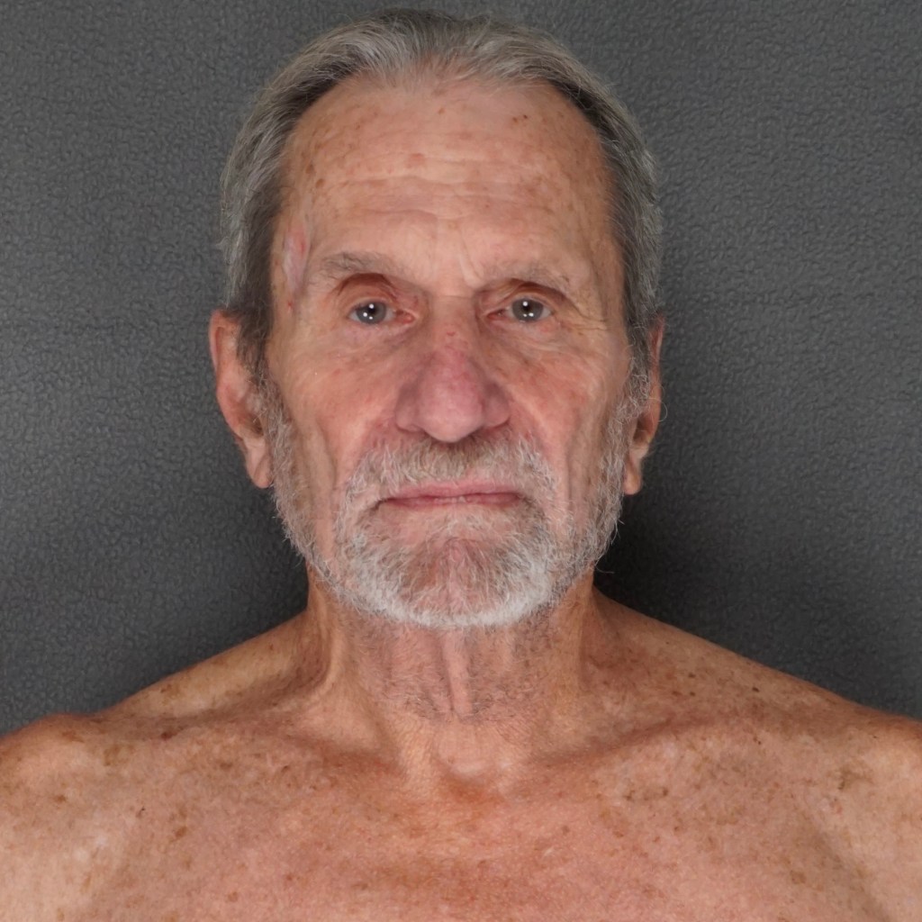 facelift neck lift lower eyelids before and after