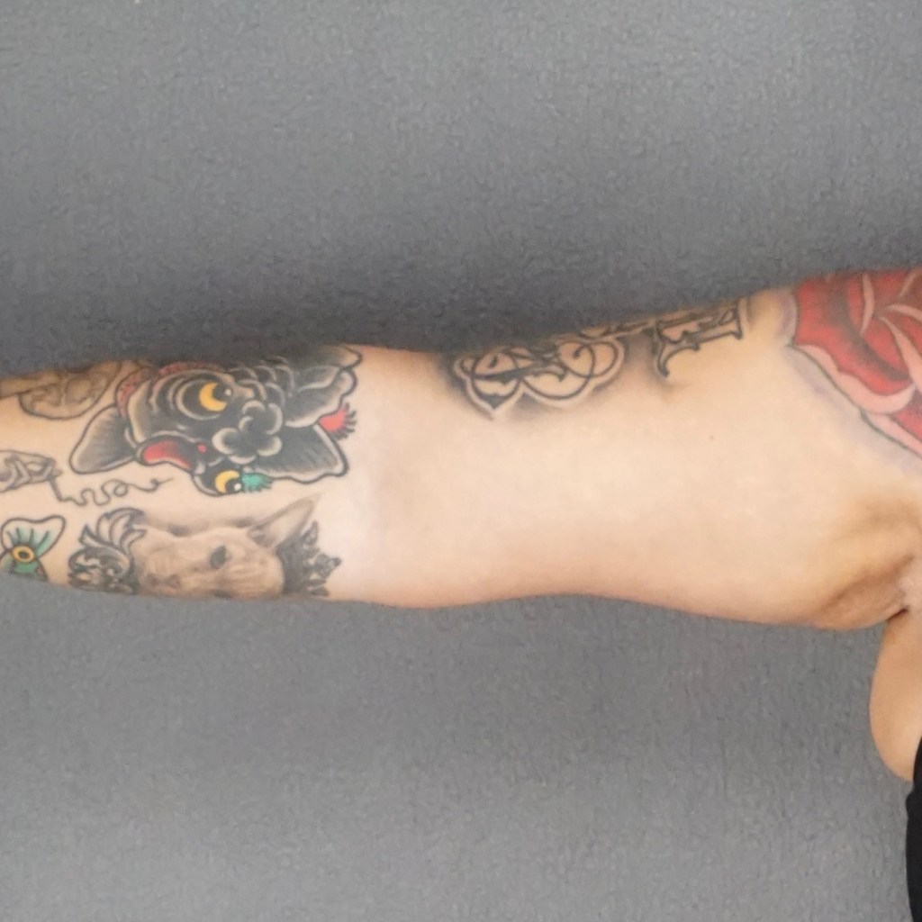 arms, brachioplasty, upper arms, fat arms, arm contouring