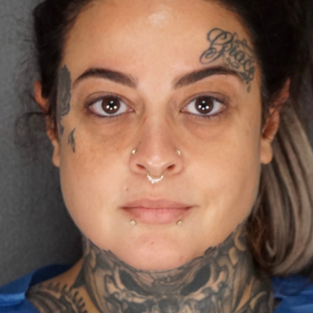 preoperative eyelids, look old, sagging eyes