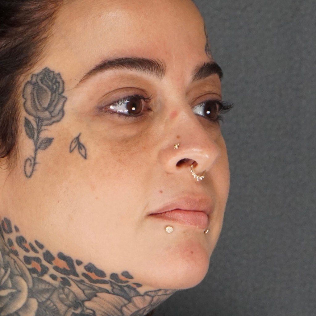 preoperative eyelids, look old, sagging eyes