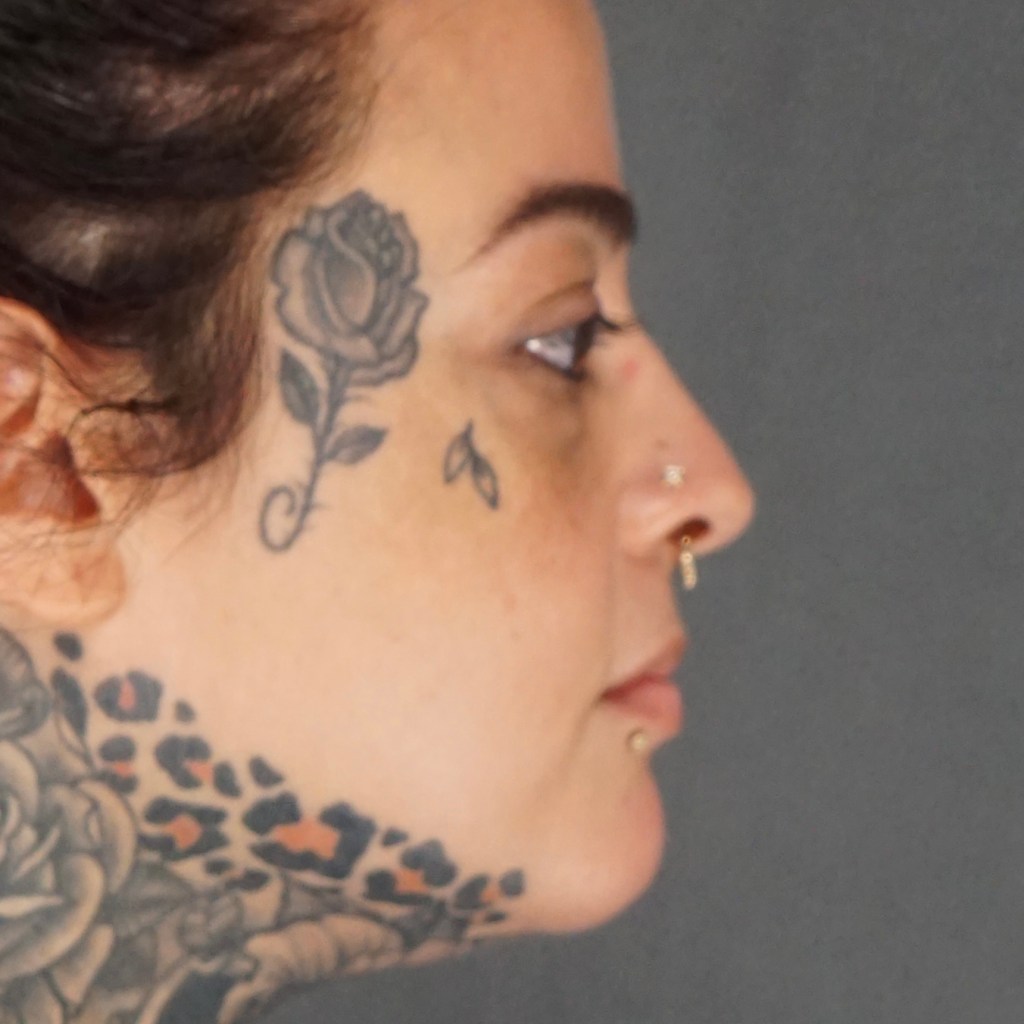 preoperative eyelids, look old, sagging eyes