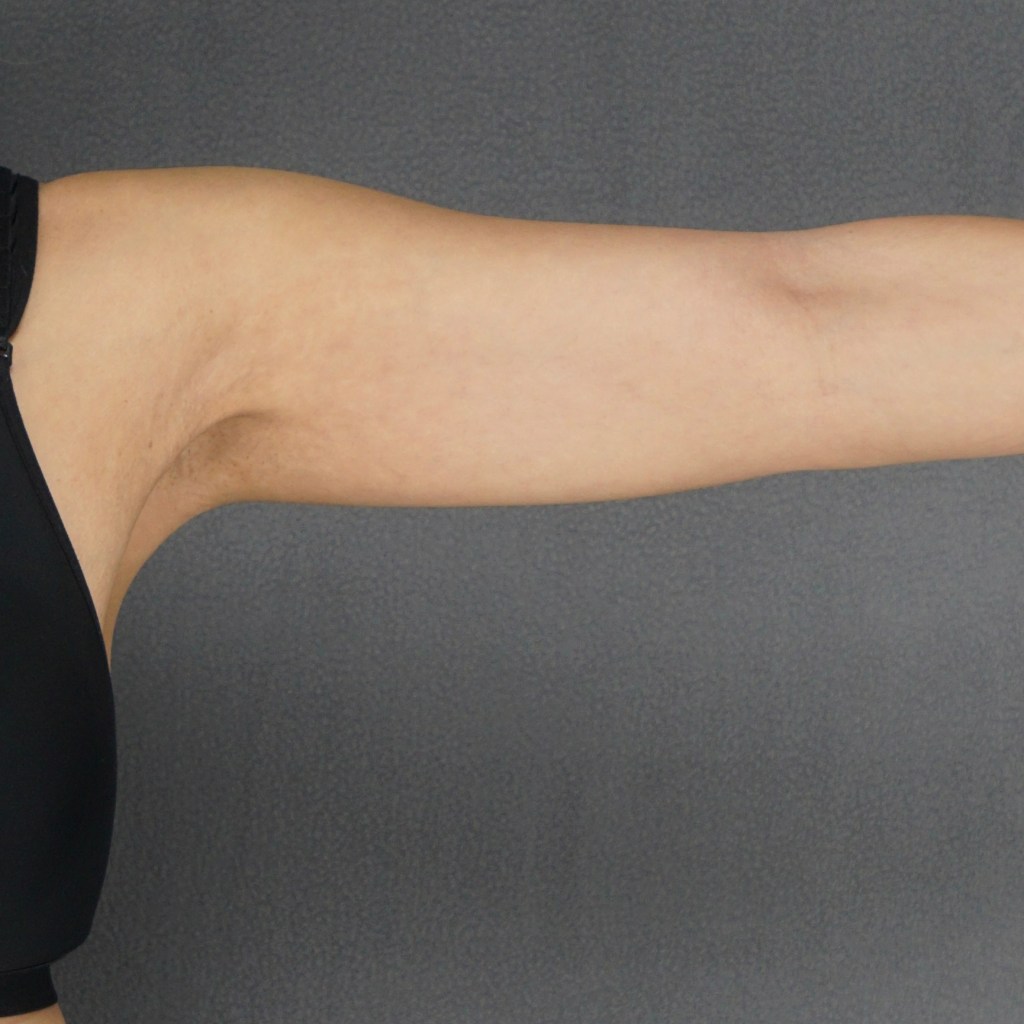 arms, brachioplasty, upper arms, fat arms, arm contouring, arm liposuction