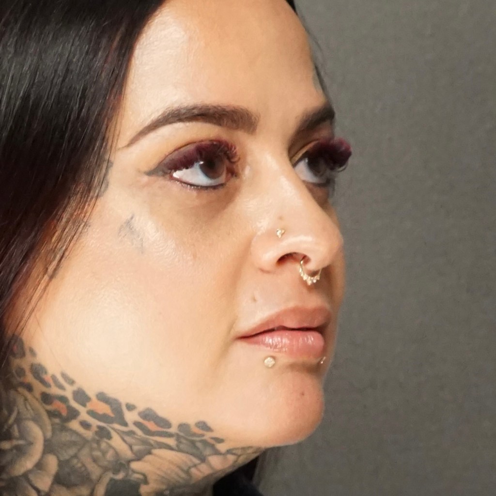 eyelid surgery, upper lower eyelid blepheroplasty, rejuvenate, younger, beautiful eyes before and after