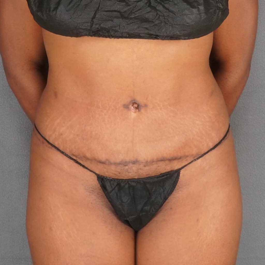tummy tuck abdominoplasty before and after