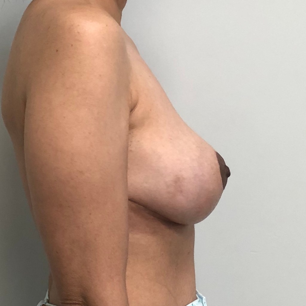 breast lift, mastopexy, breast sagging before and after