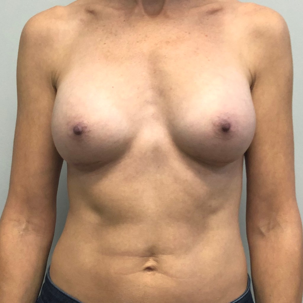 breast augmentation, breast implants before and after
