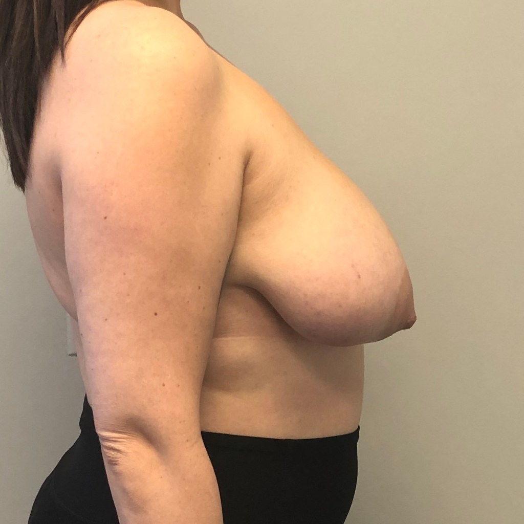 breast lift mastopexy breast reduction before and after