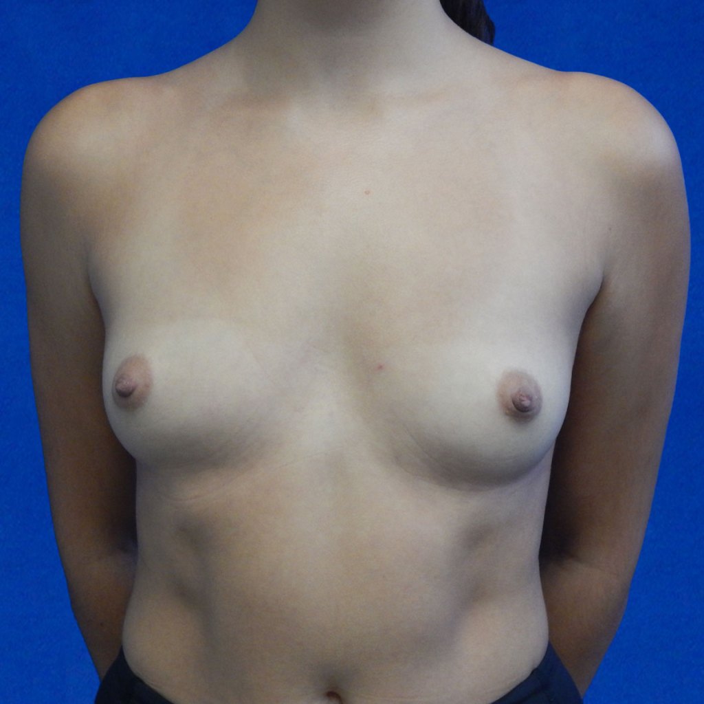 breast augmentation, breast before and after