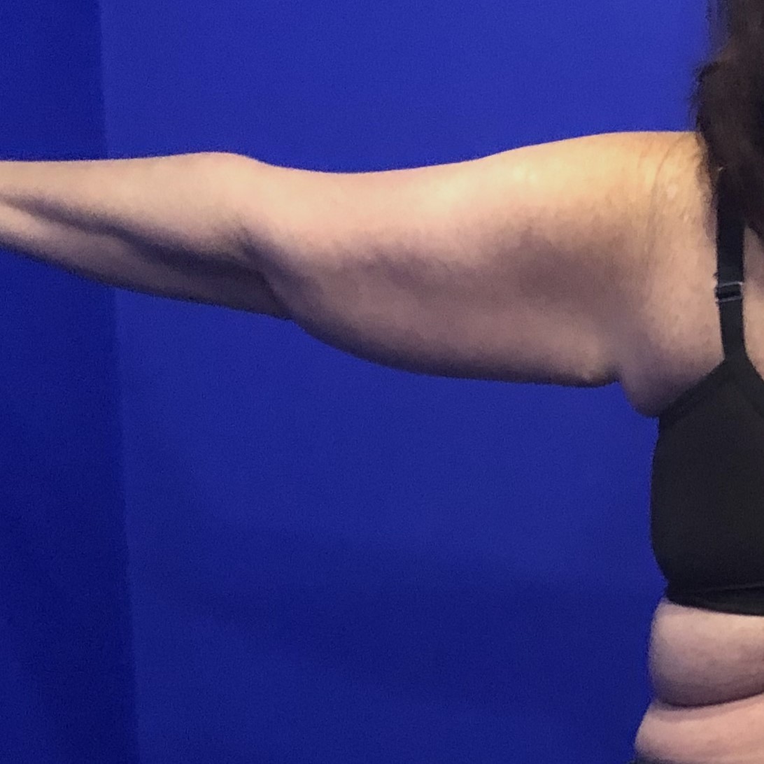 Brachioplasty arm lift before natural results - Dr. Elkowitz Great Neck NY