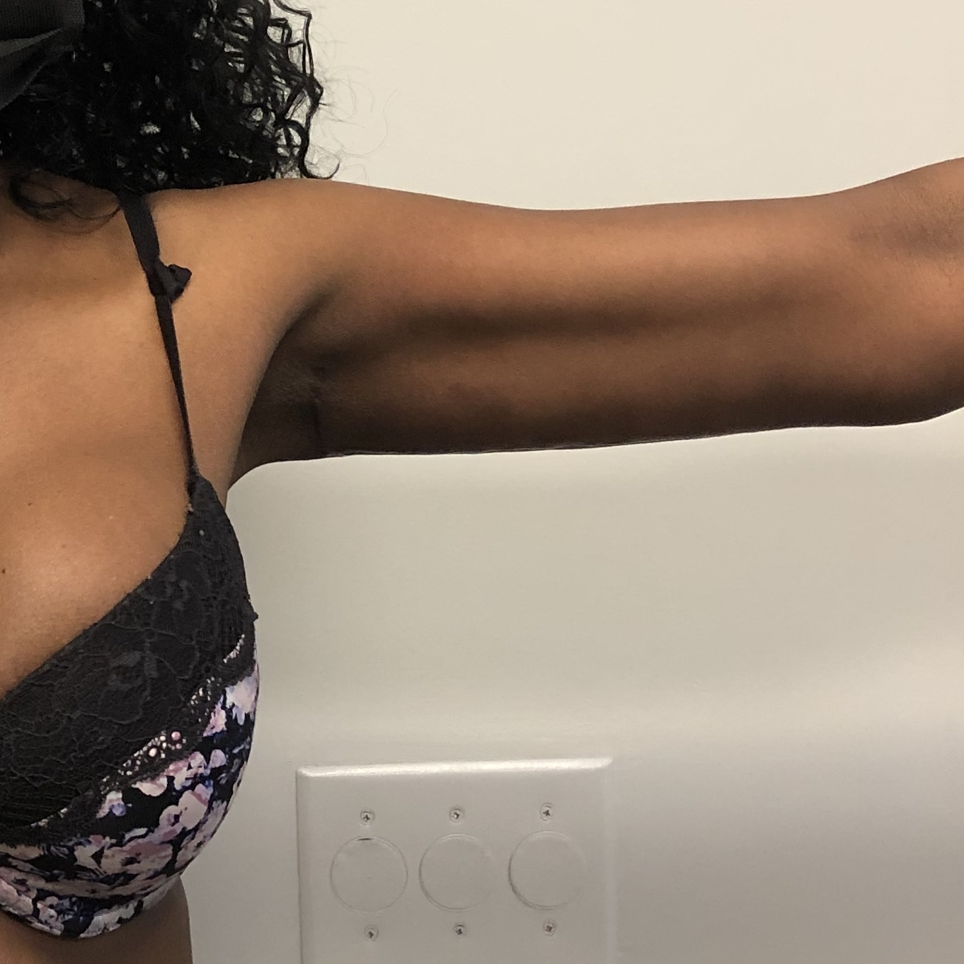 Brachioplasty arm lift liposuction after natural results - Dr. Elkowitz Great Neck NY