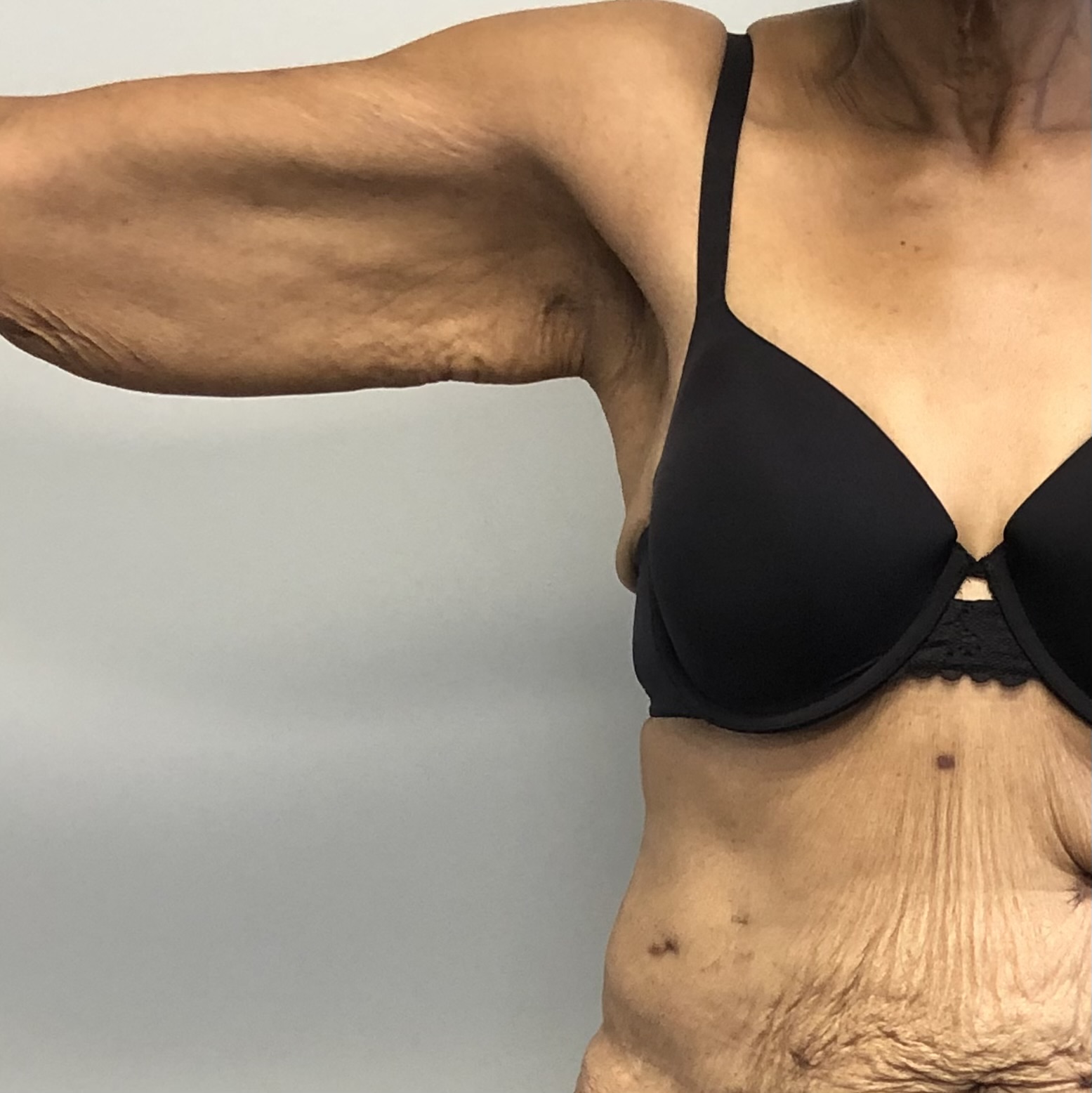 Brachioplasty arm lift liposuction before natural results - Dr. Elkowitz Great Neck NY