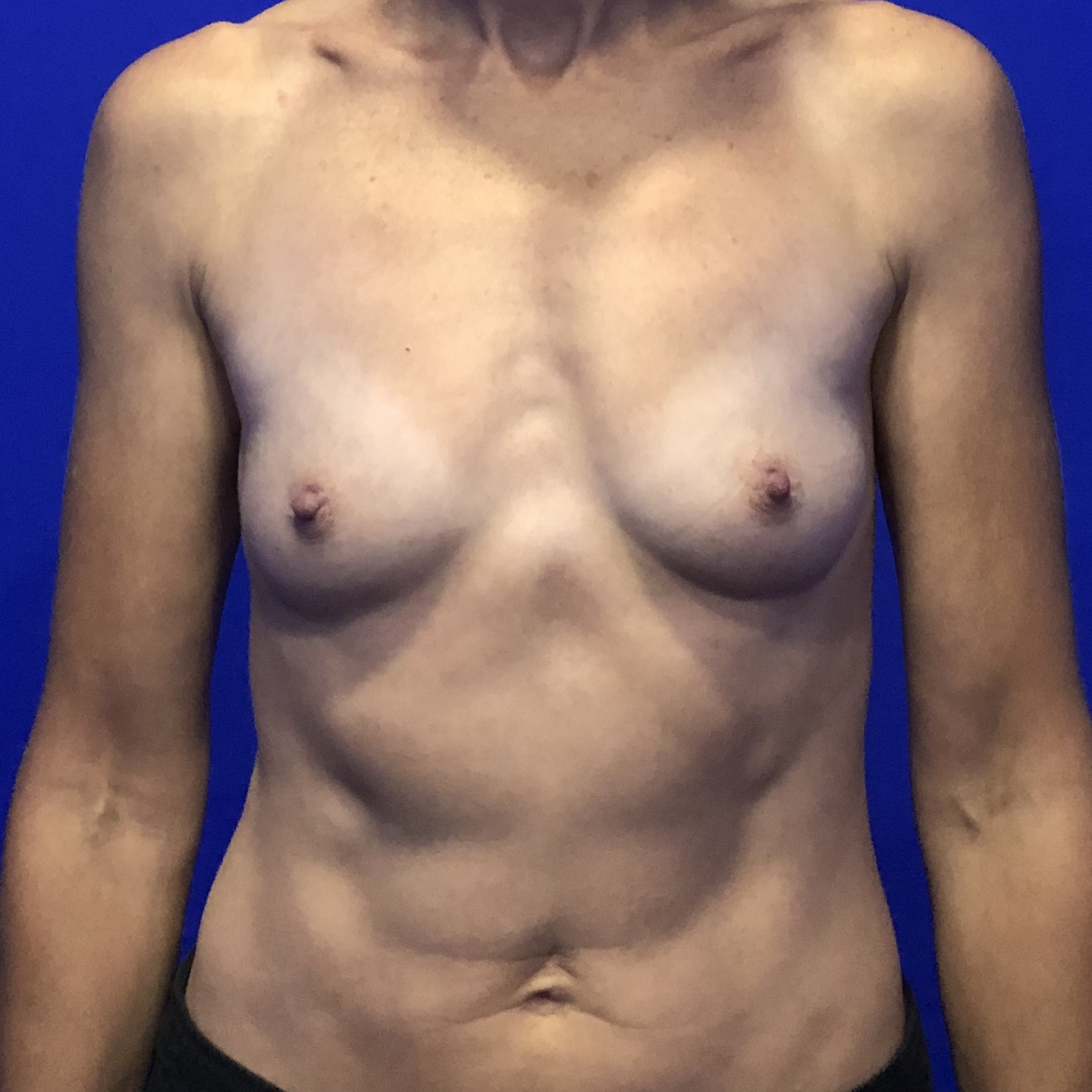 Breast augmentation before natural results - Dr. Elkowitz Great Neck NY