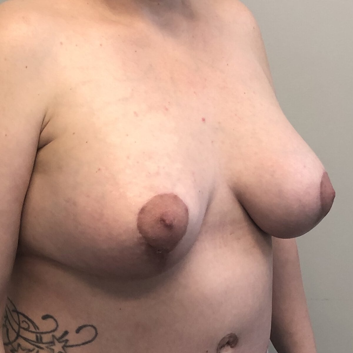 oblique post operative view of a middle-aged woman with significant breast, ptosis preoperative for breast augmentation and breast lift mastopexy