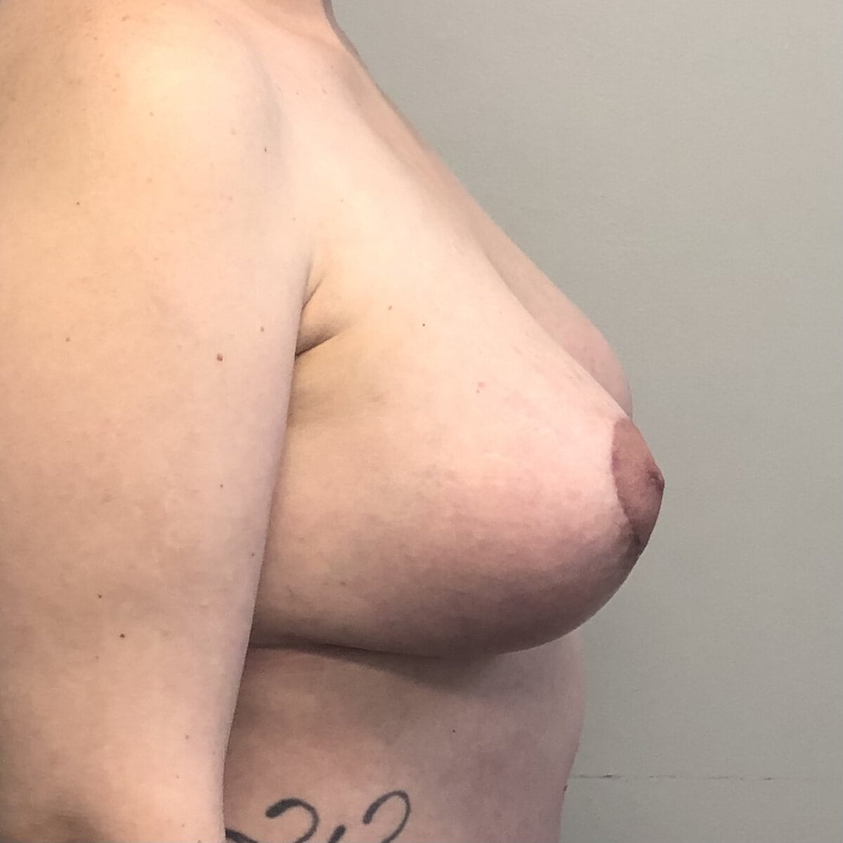 lateral view post operative view of a middle-aged woman with significant breast, ptosis preoperative for breast augmentation and breast lift mastopexy