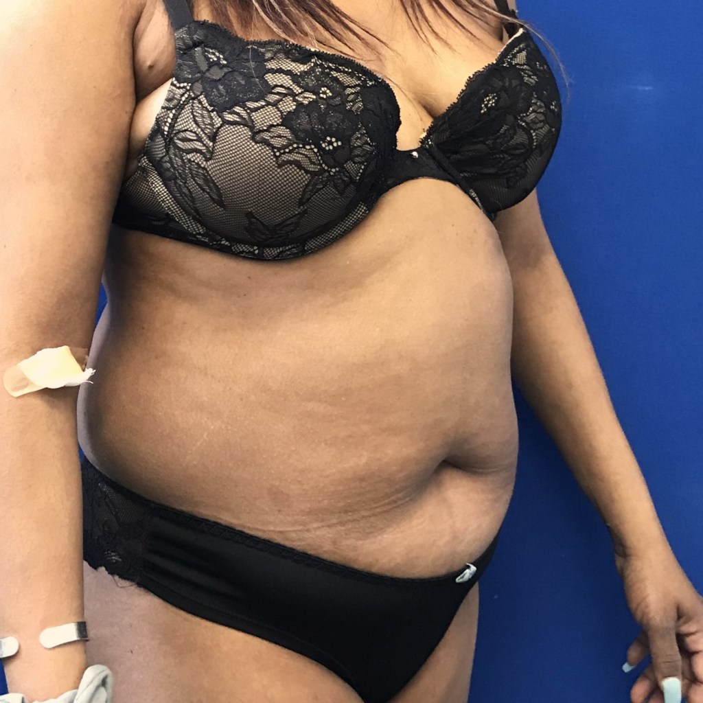 tummy tuck abdominoplasty before and after