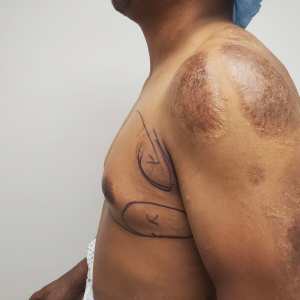 Middle-aged man history of burns gynecomastia correction with open excision and nipple lift before and after – Plastic Surgery of New York – pre op side view with surgical markings