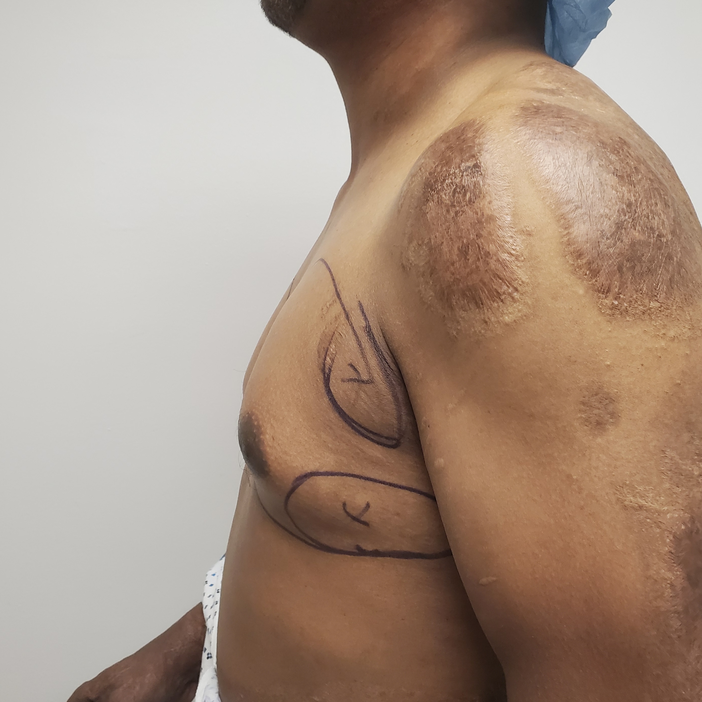 Middle-aged man history of burns gynecomastia correction with open excision and nipple lift before and after – Plastic Surgery of New York – pre op side view with surgical markings