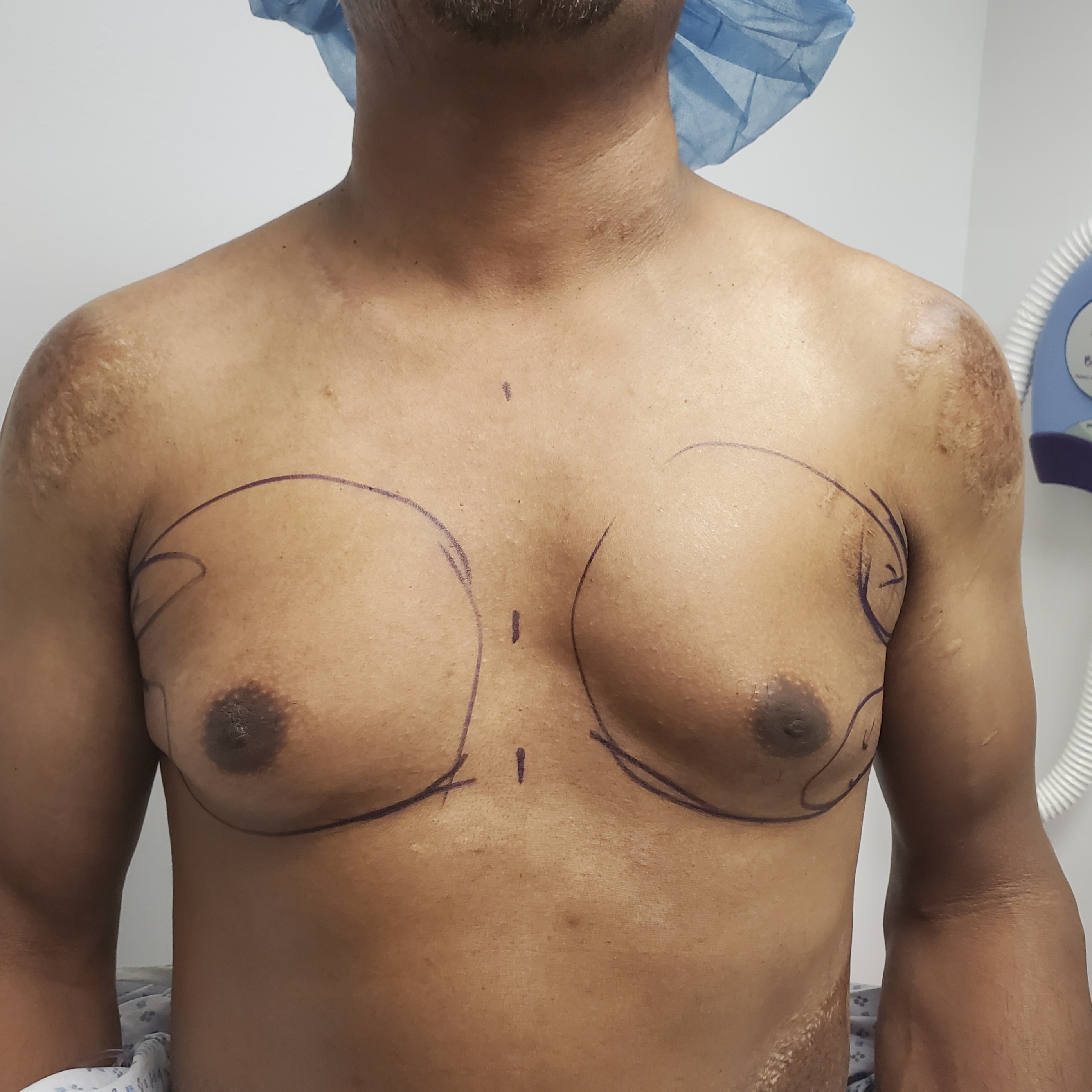 Homme d'âge mûr, antécédents de brûlures, correction de gynécomastie par excision ouverte et lifting du mamelon avant et après – Chirurgie Plastique de New York, montrant la planification préopératoire