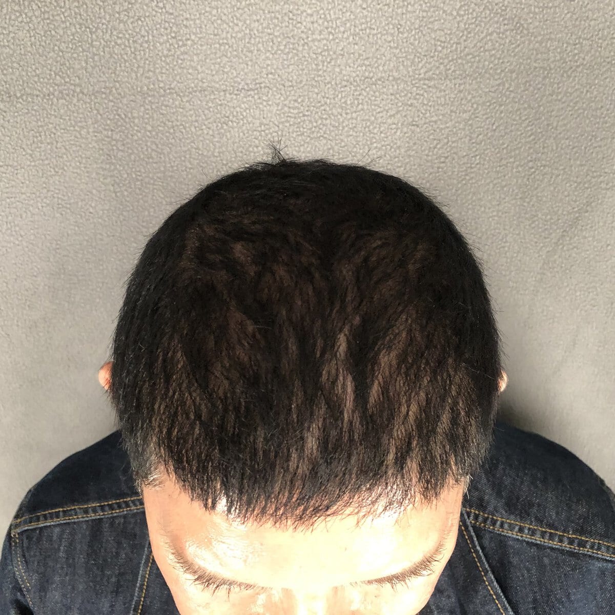 Top-down view of man's hairline and crown after FUE hair transplant, natural coverage – Plastic Surgery of New York