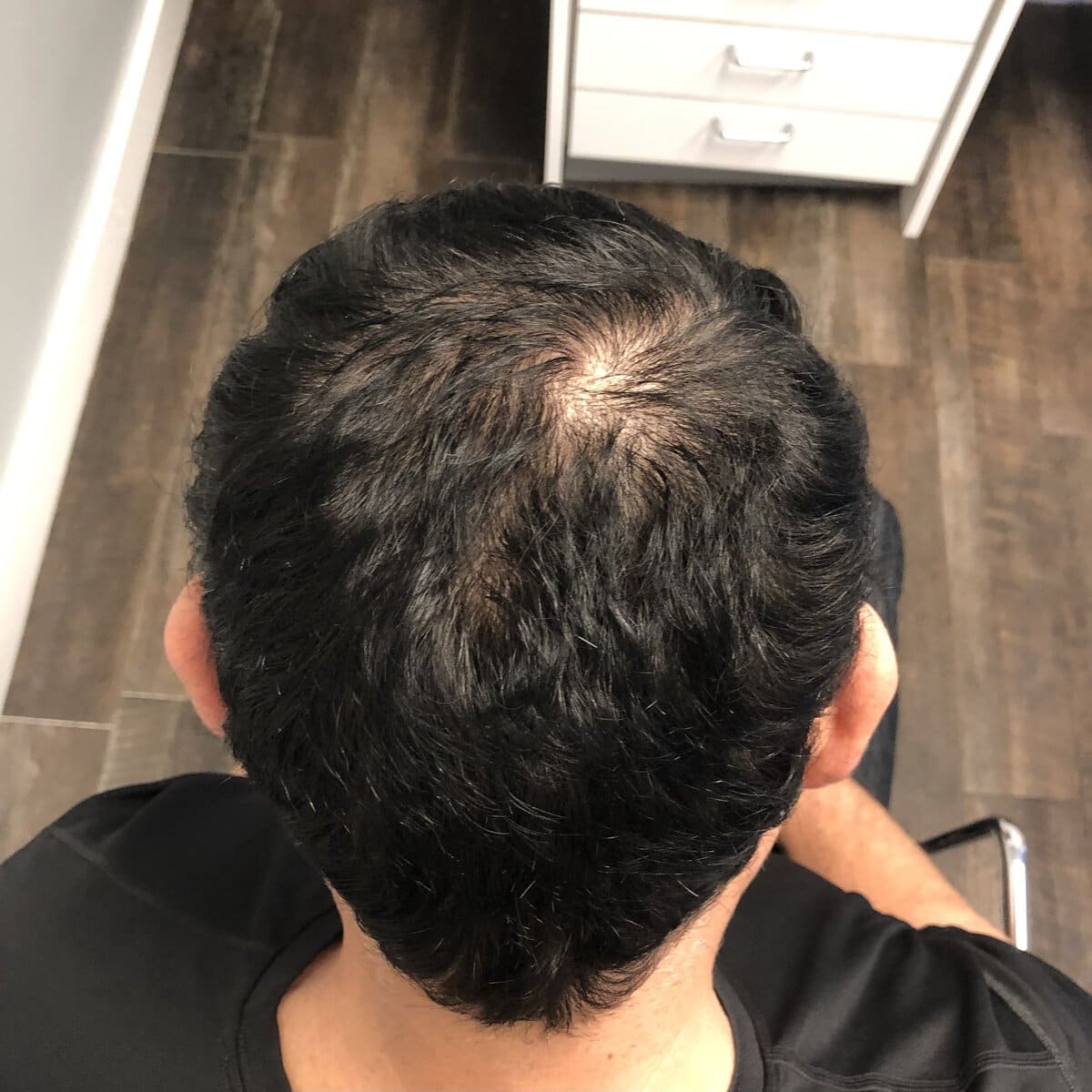 Top-down view of man's thinning crown before FUE hair transplant surgery – Plastic Surgery of New York