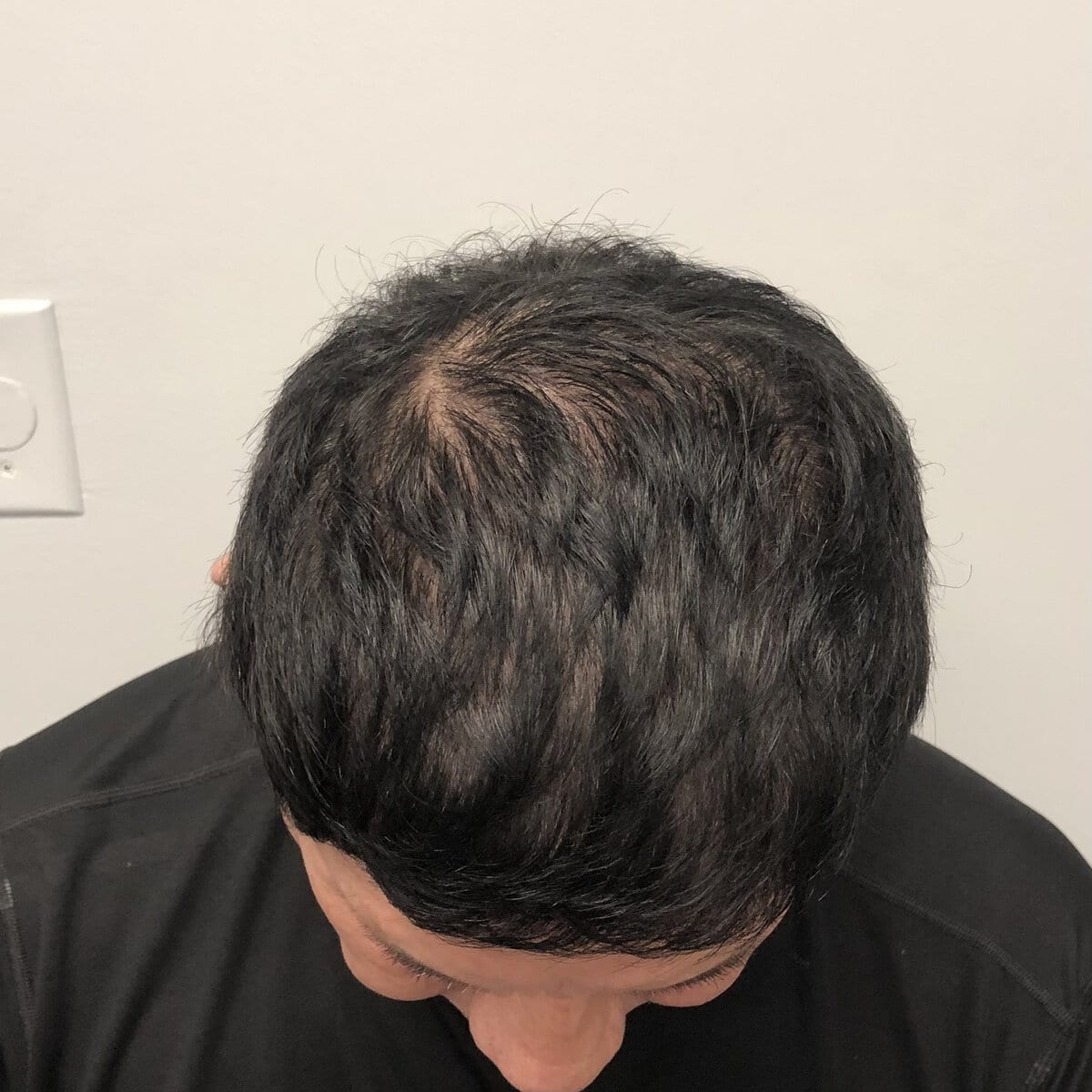 Top-down view of man's thinning hairline and crown before hair transplant surgery, different session – Plastic Surgery of New York